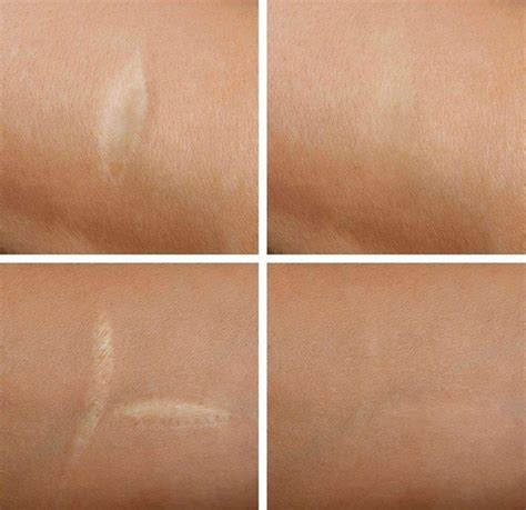 dallas best tattoo studio for scars|Scar & Stretch Mark Camouflage Tattoo in Dallas .